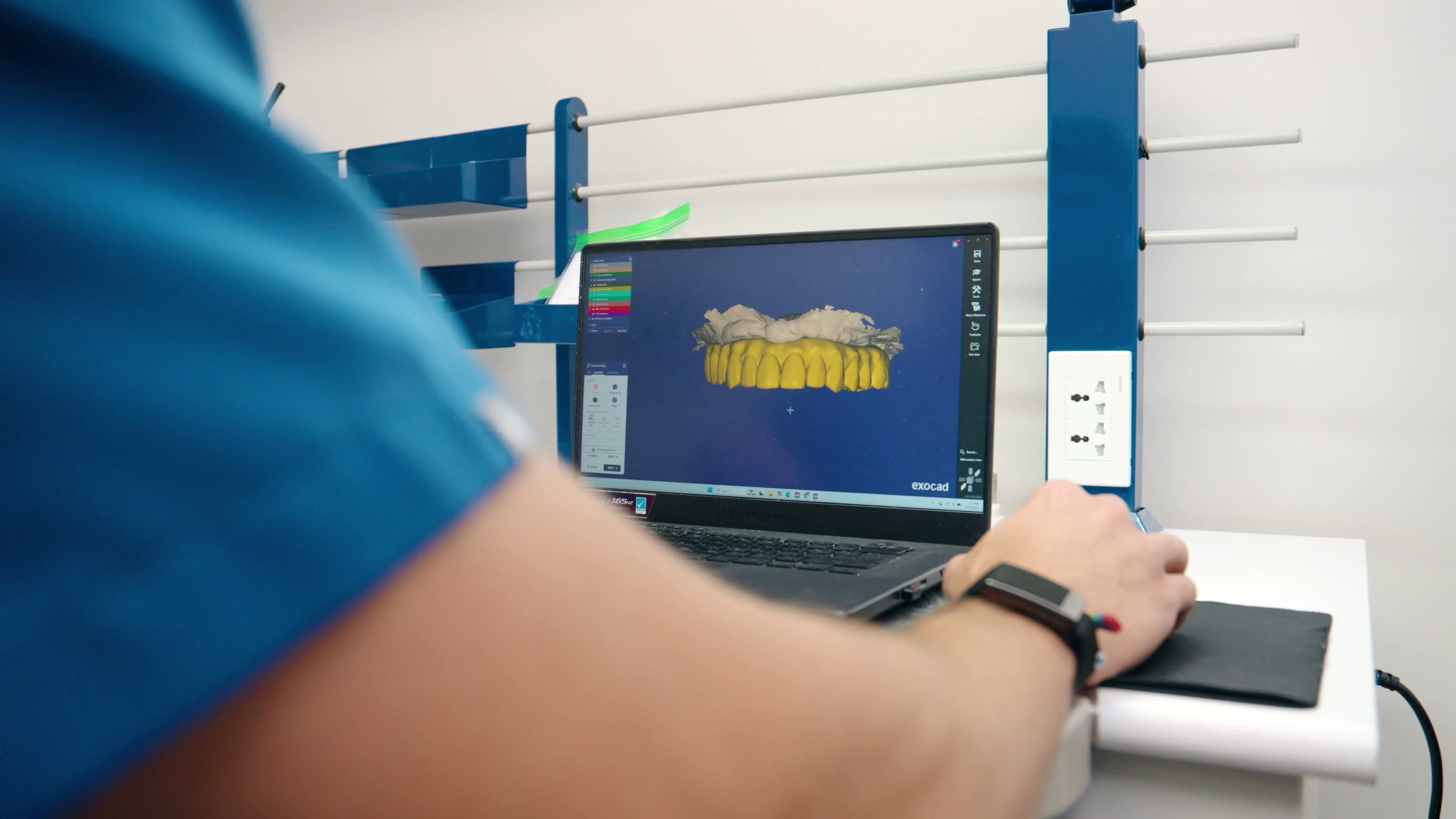A three-dimensional scan of a dental arch on a chairside laptop